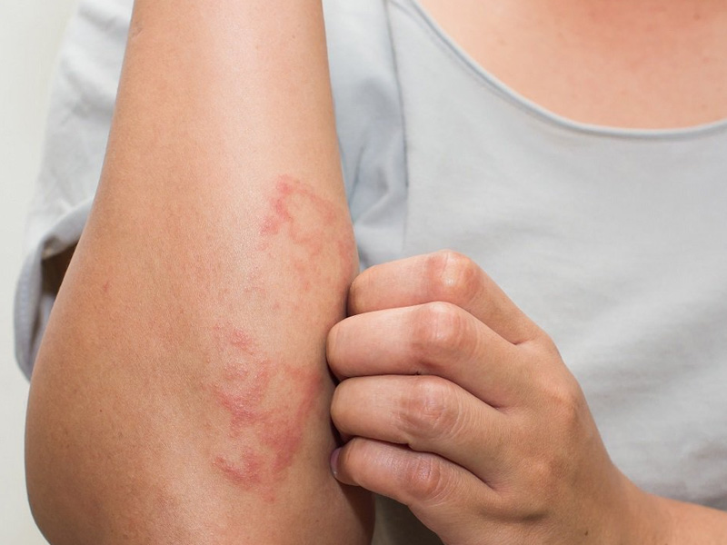 皮膚癢 = 肝不好、排毒功能差? 皮膚癢 = 肝不好、排毒功能差?
