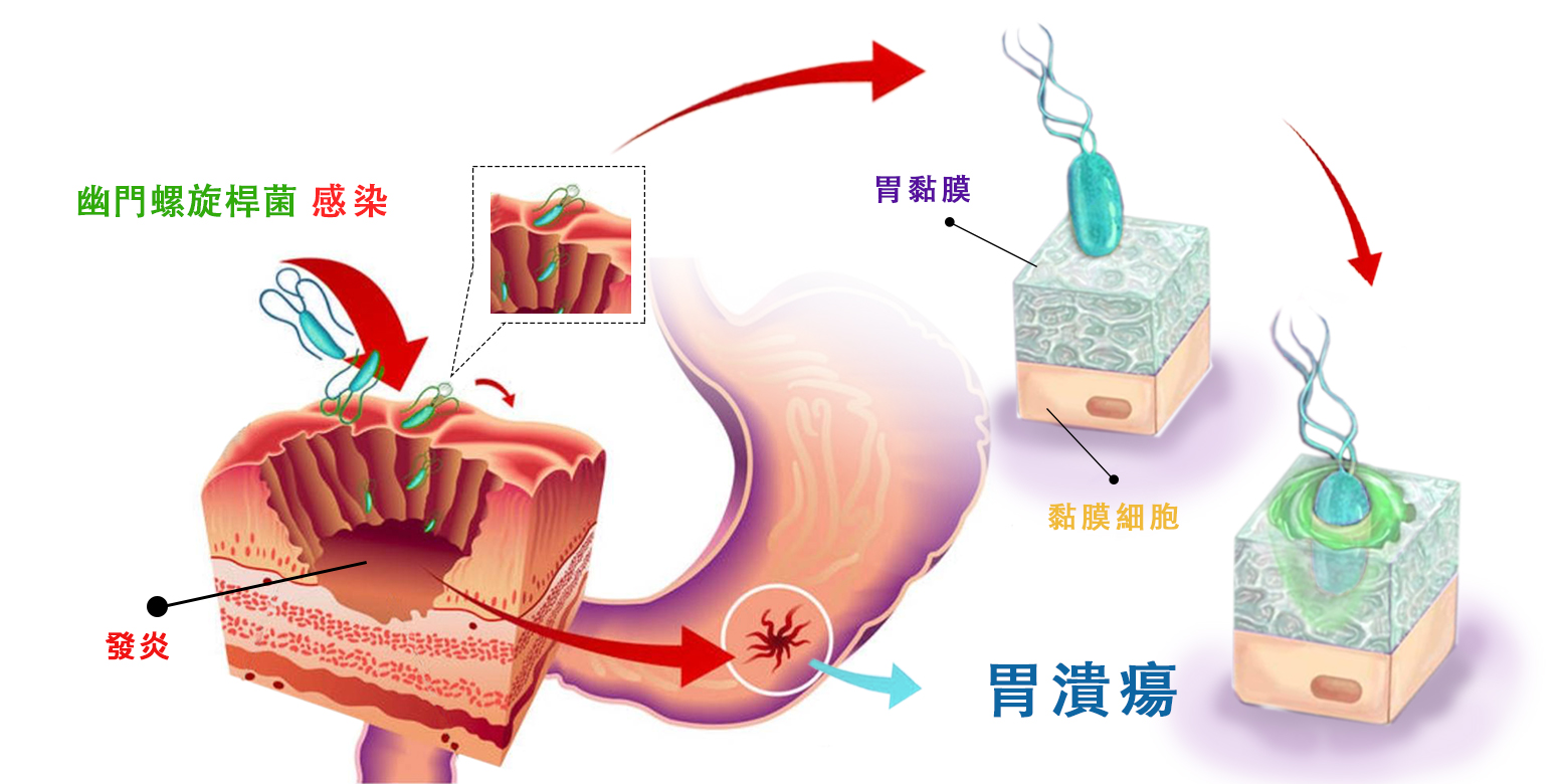 吃大蒜可以殺死幽門螺桿菌？