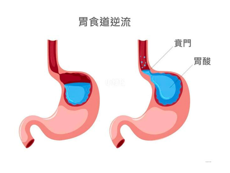 4種方法紓緩胃食道逆流 4種方法紓緩胃食道逆流