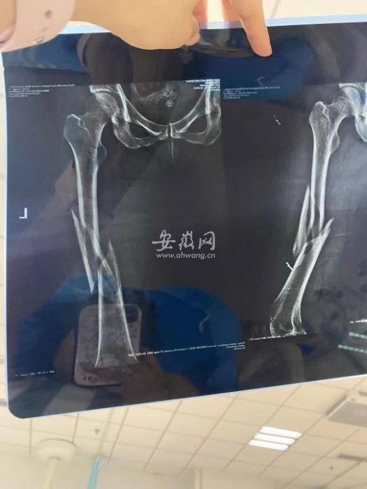 上瑜珈課被教練壓斷大腿 店家想賠5萬元了事