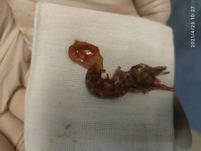 14歲少年塞生猛小龍蝦入肛門 原因嚇壞網民 ...