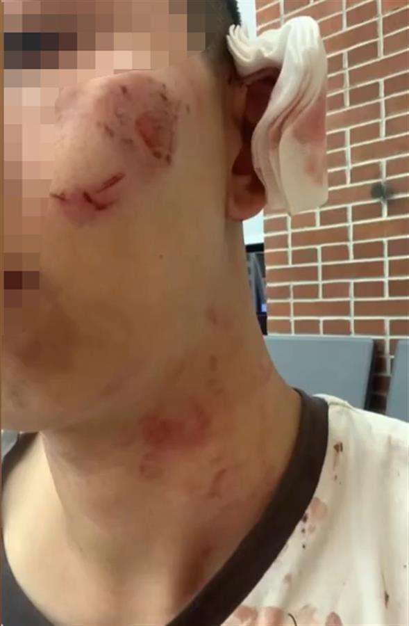 喪屍出沒？男子遭狂咬 還被撕破內褲