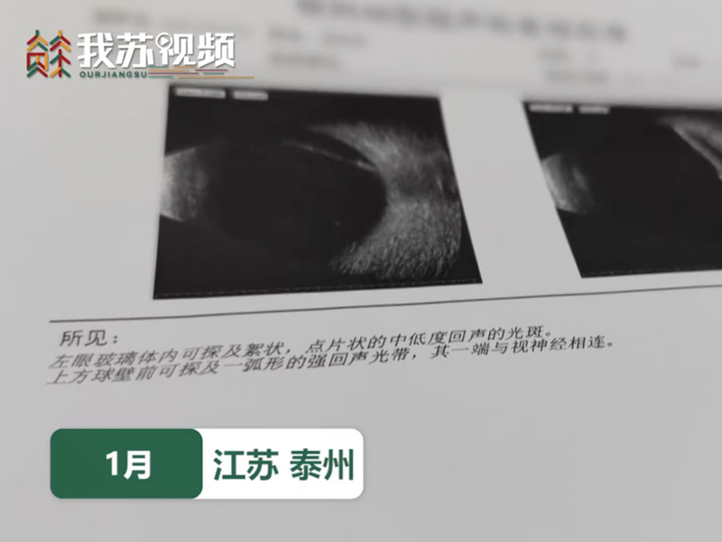 近視女子 劇烈咳嗽後 視網膜脫落