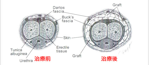 陰莖增大手術失敗 縮剩五分一怒控醫生