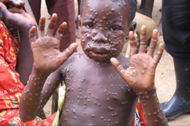 猴痘 Monkeypox 全球膿瘡病毒病例破千