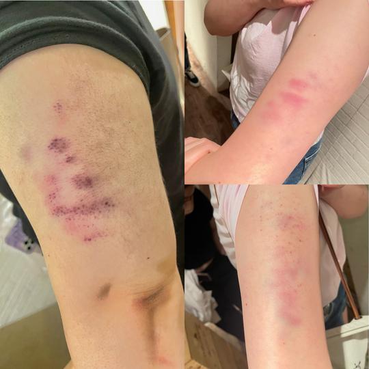 熱石按摩 按到要睇骨科