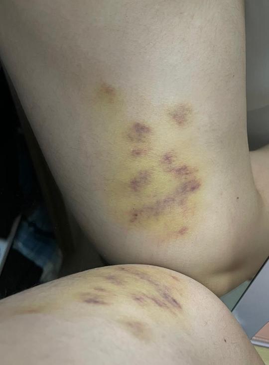 熱石按摩 按到要睇骨科