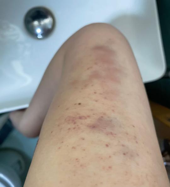 熱石按摩 按到要睇骨科