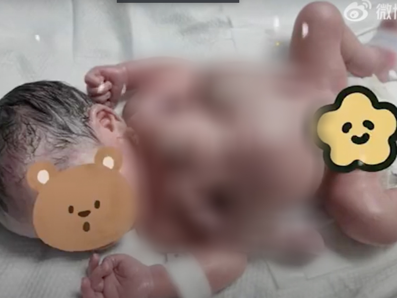 全球罕見！深圳一男嬰出生時4手4腳
