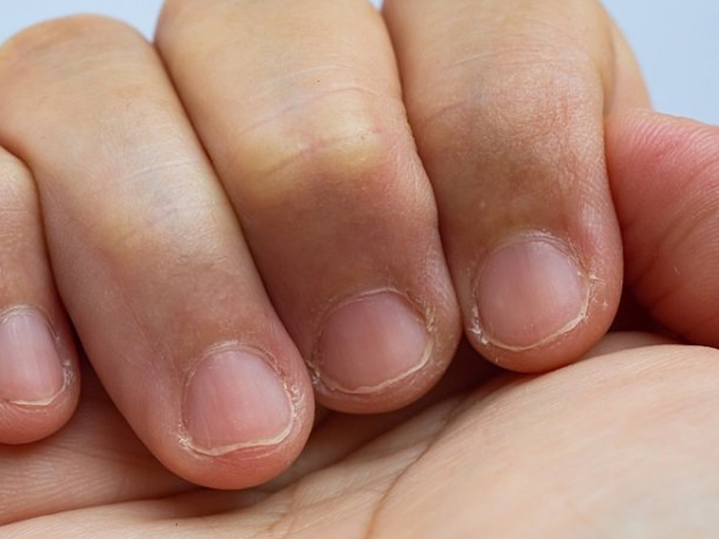 你所不知道 指甲隱藏的健康信息 你所不知道 指甲隱藏的健康信息