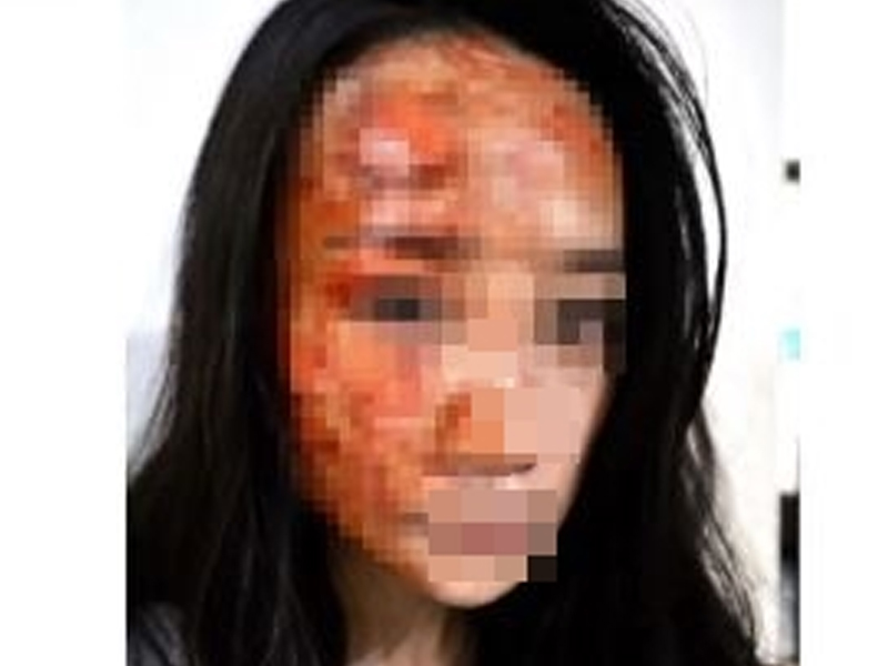 KTV 遭潑熱湯恐毀容 傷者更新自拍照 最新傷勢曝光