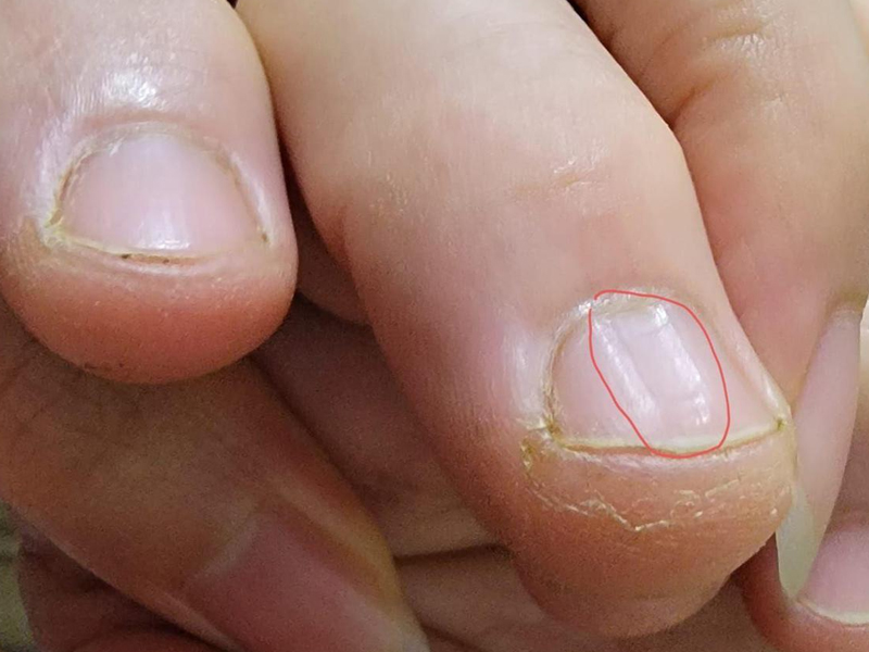 指甲出現 4 異常,是癌或疾病的預警 指甲出現 4 異常,是癌或疾病的預警