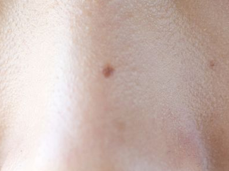 男人生殖器上有痣代表什麼？