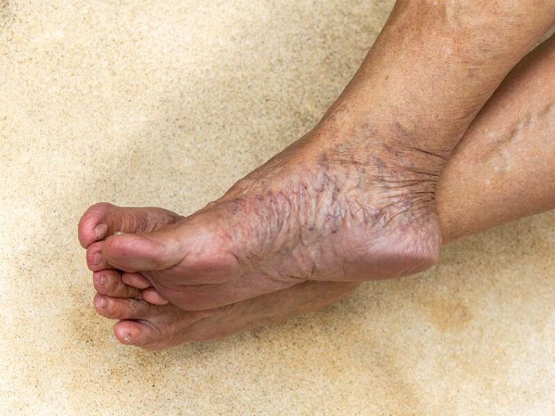 當腳有 3 大異樣時,提示肝臟受損了 當腳有 3 大異樣時,提示肝臟受損了