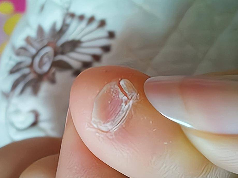 小腳趾指甲分成兩瓣的人,到底是什麼來歷? 小腳趾指甲分成兩瓣的人,到底是什麼來歷?