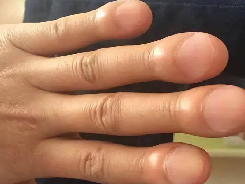 指甲一異常變化,恐是肺癌先兆 指甲一異常變化,恐是肺癌先兆