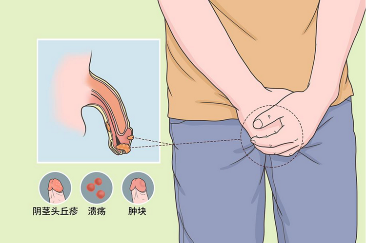 研究發現：吸煙引致陰莖癌