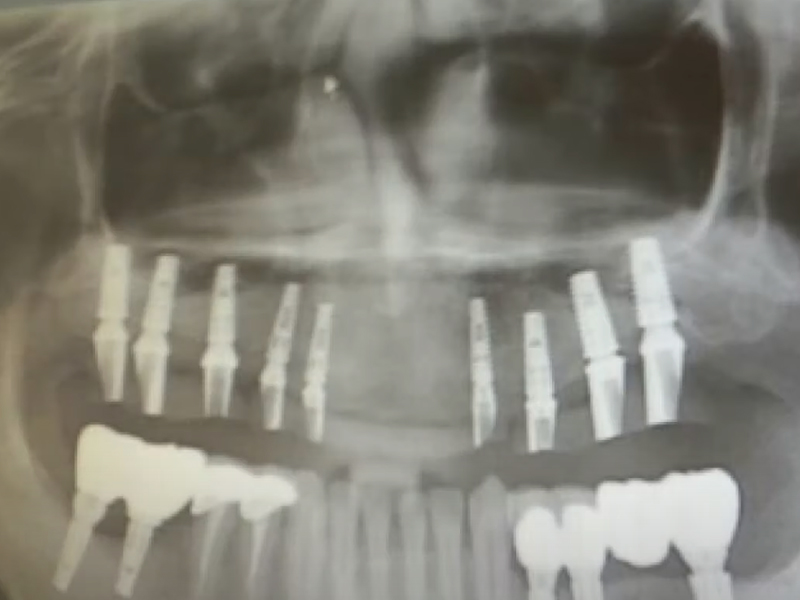 61 歲中國男子，韓國種牙後吐血身亡