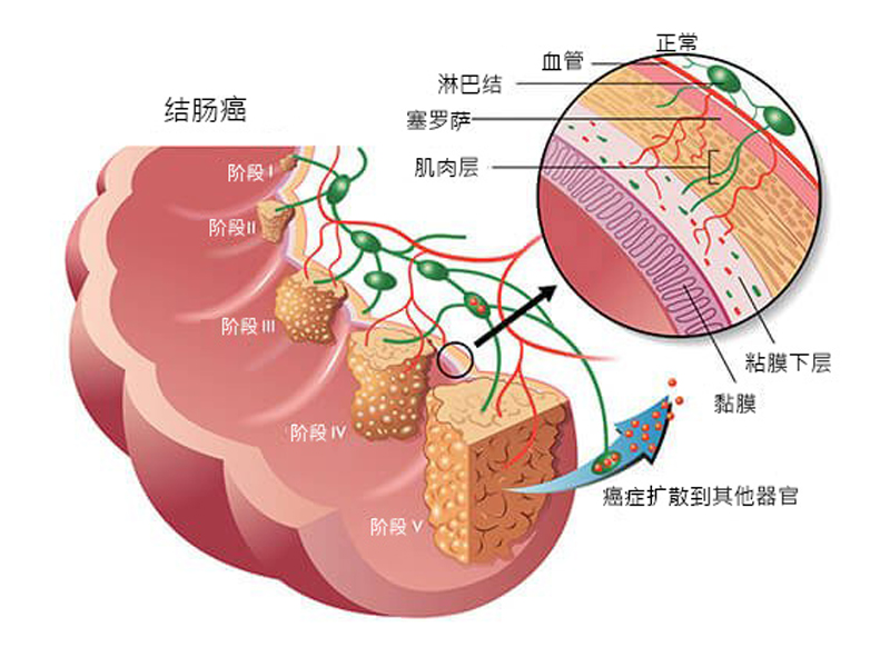 男子大腸癌 4 期!每天一食物癌細胞未再復發 男子大腸癌 4 期!每天一食物癌細胞未再復發
