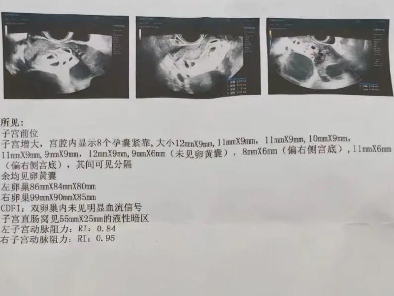 25 歲女子懷九胎,醫生建議兩次減胎手術 25 歲女子懷九胎,醫生建議兩次減胎手術