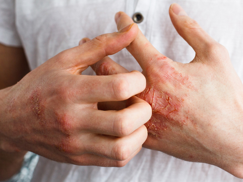 濕疹常見困擾問題，補益生菌能緩解症狀