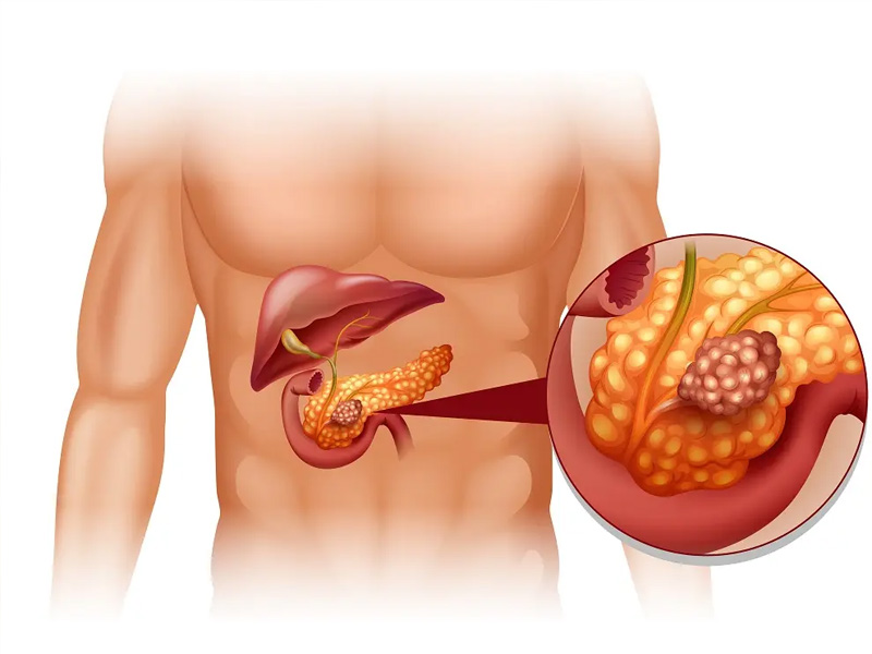 胰腺癌早期癥狀:腹痛、脂肪便需警惕 胰腺癌早期癥狀:腹痛、脂肪便需警惕