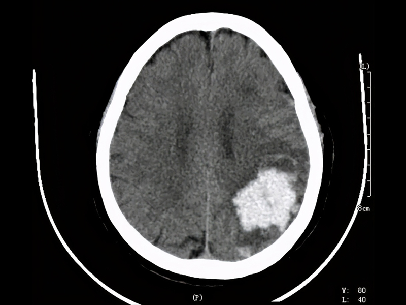 7 點起床 1 點睡覺,腦幹出血 ICU 抢救 7 點起床 1 點睡覺,腦幹出血 ICU 抢救