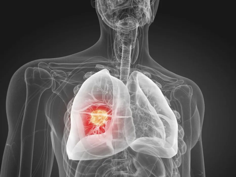 肺結節與惡性肺癌的關係：早發現早治療