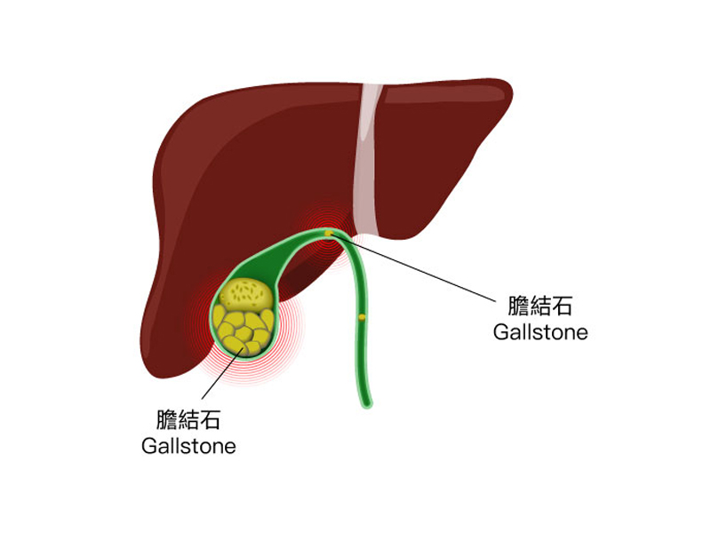 膽結石:成因、症狀及治療全解析 膽結石:成因、症狀及治療全解析
