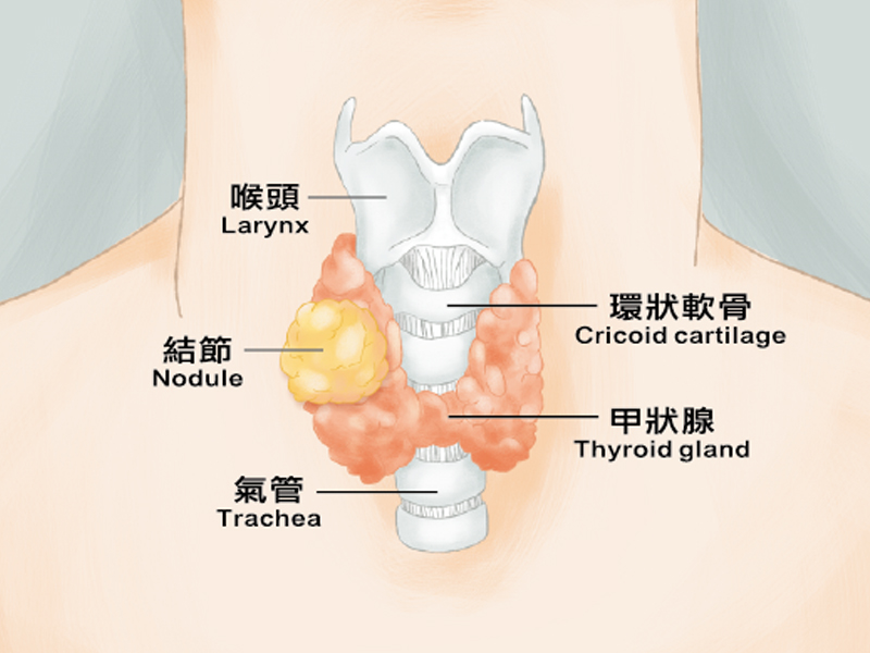 香港 10 癌 1 甲!甲狀腺檢查必須做 香港 10 癌 1 甲!甲狀腺檢查必須做