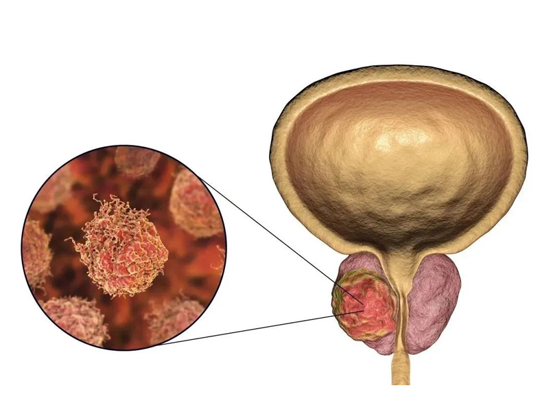 前列腺癌早期信號暗藏 這些身體警報別輕忽