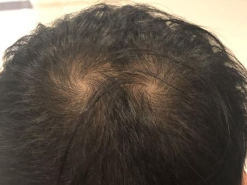 為什麼頭髮會有旋?為什麼有的人沒有旋 為什麼頭髮會有旋?為什麼有的人沒有旋